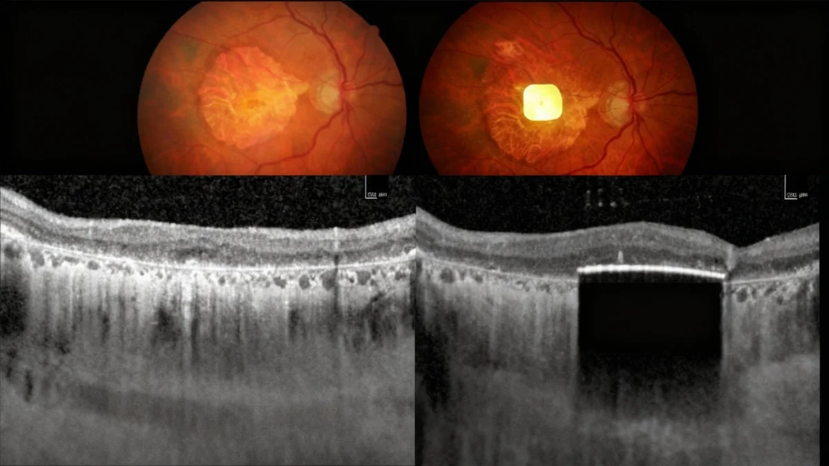 Neues Netzhaut-Implantat stellt Sehkraft bei Makuladegeneration wieder her